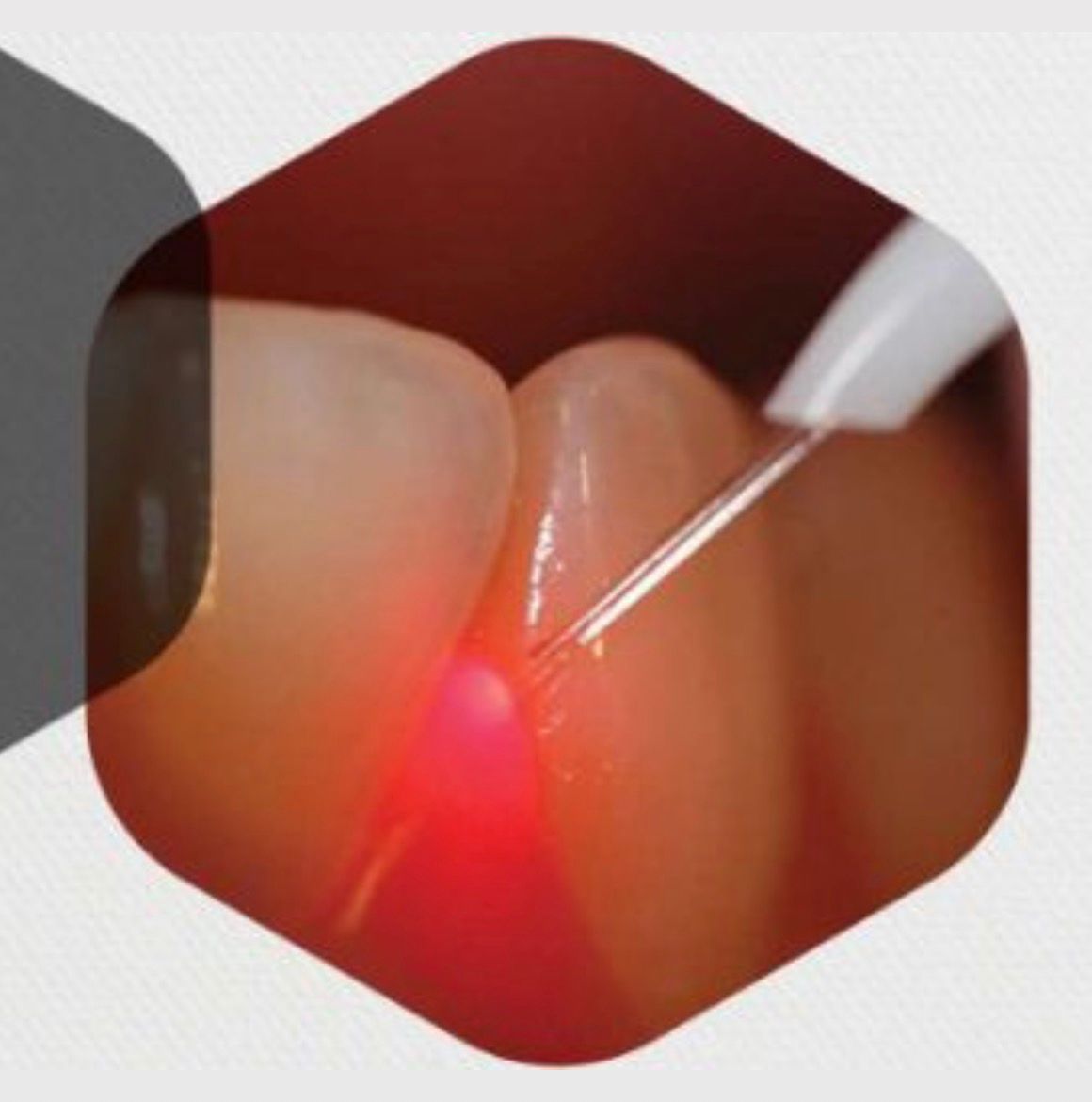 Gum Treatment