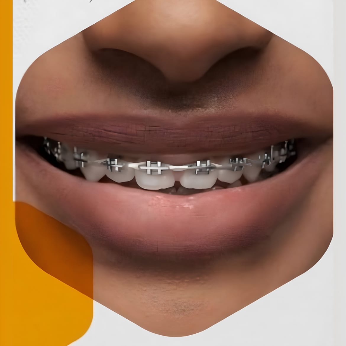 Orthodontic Treatment (Braces)