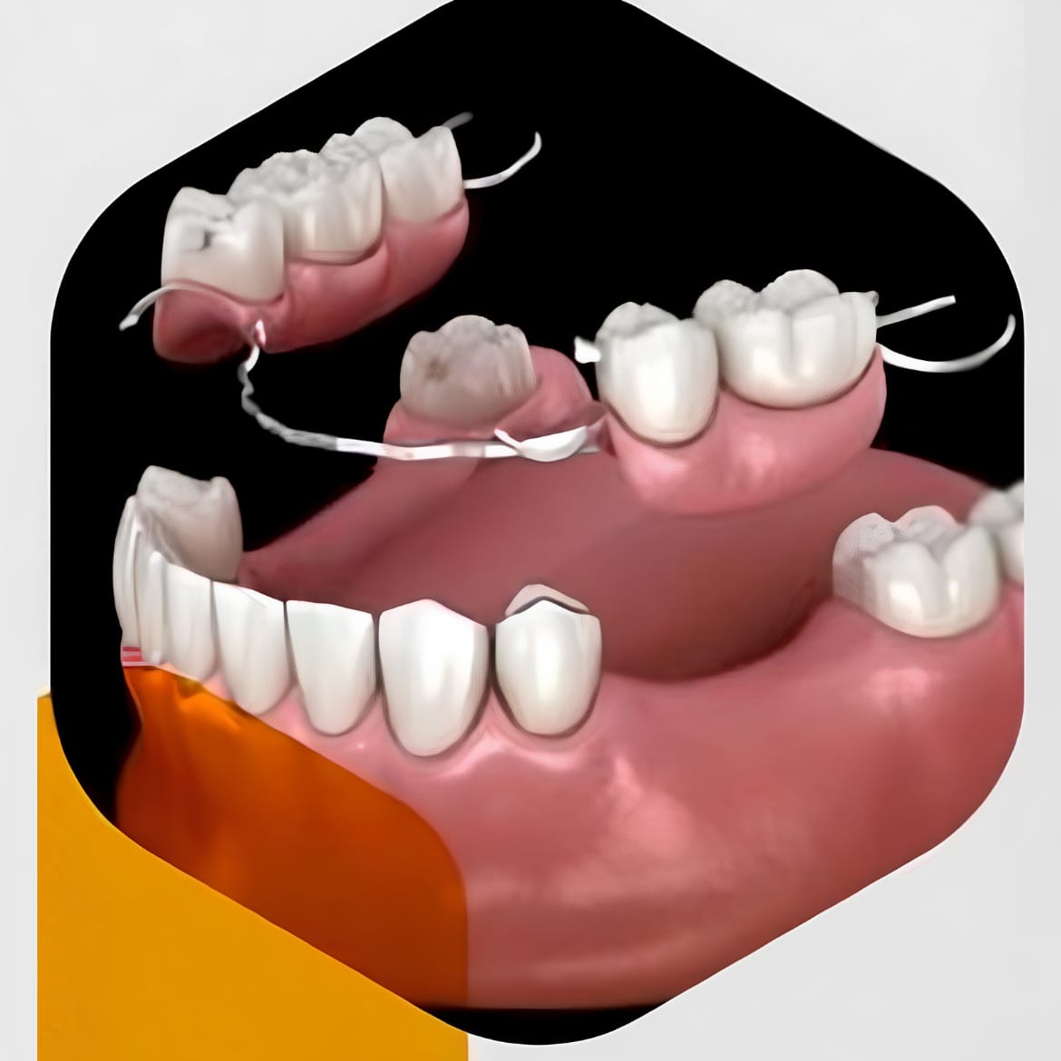 Dentures