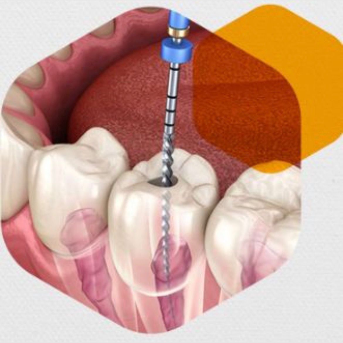 Root Canal Therapy