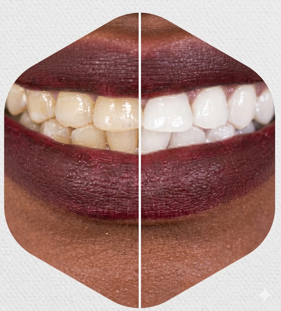 Teeth Cleaning